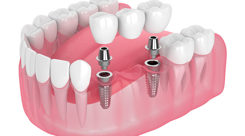 Vale a pena fazer implante dentário em 2024?