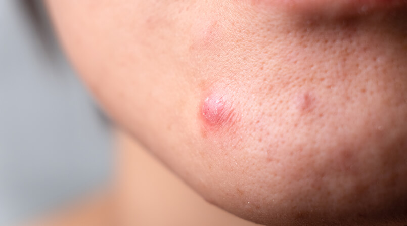 3 dicas para você prevenir acne